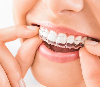 Invisalign Invisalign